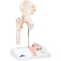 Fabrication Enterprises 3B® Anatomical Model - Femoral Fracture and Hip Osteoarthritis 978091